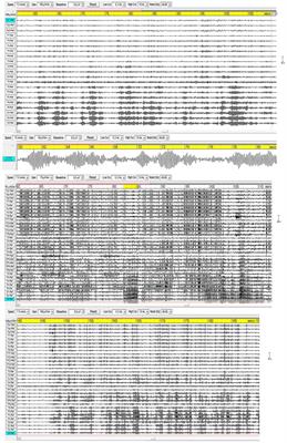 The Human Default Consciousness and Its Disruption: Insights From an EEG Study of Buddhist Jhāna Meditation